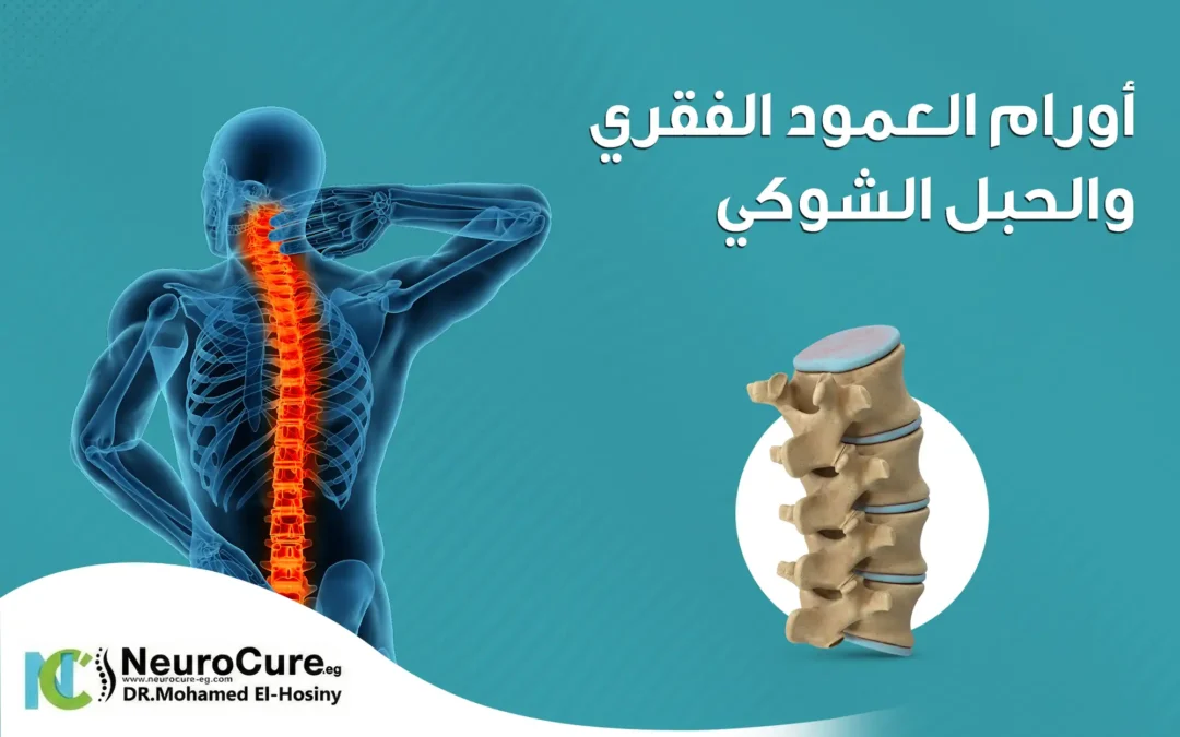 أورام العمود الفقري والحبل الشوكي: الأعراض| الأسباب| العلاج 