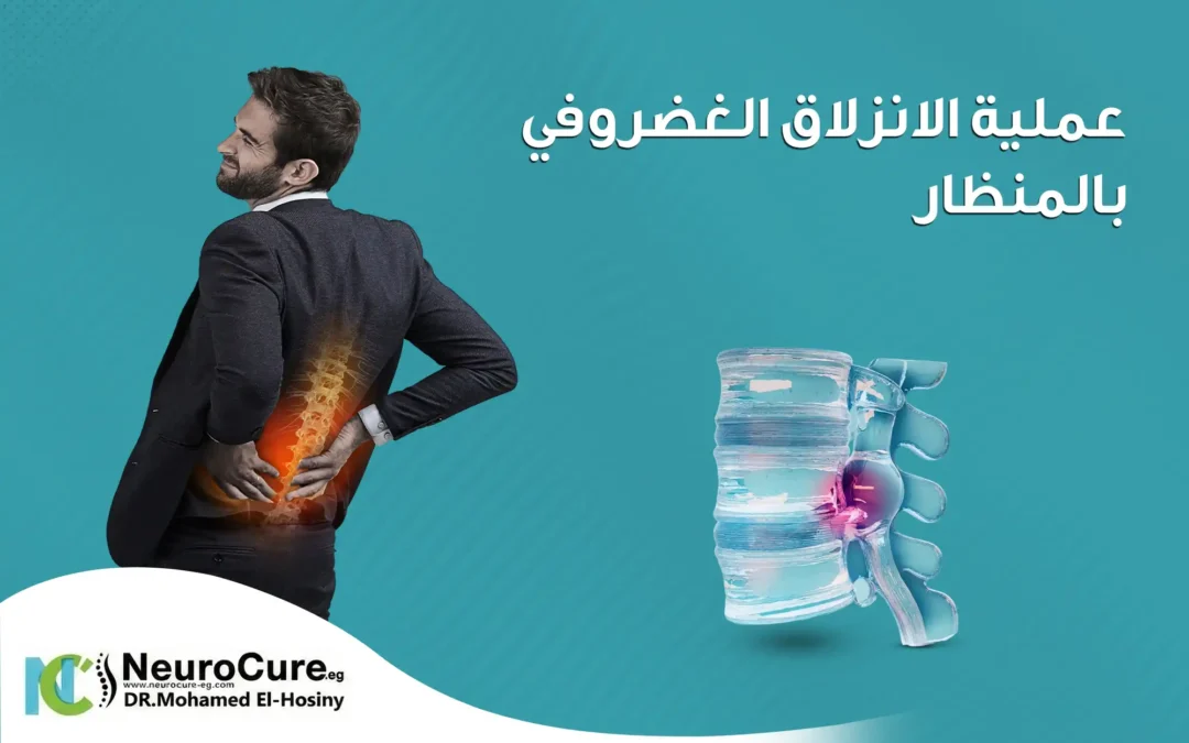 علاج الانزلاق الغضروفي بالمنظار