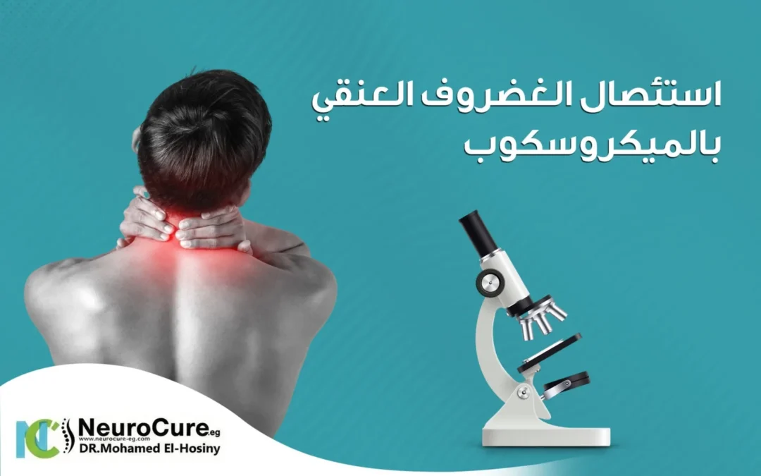 استئصال الغضروف العنقي بالميكروسكوب