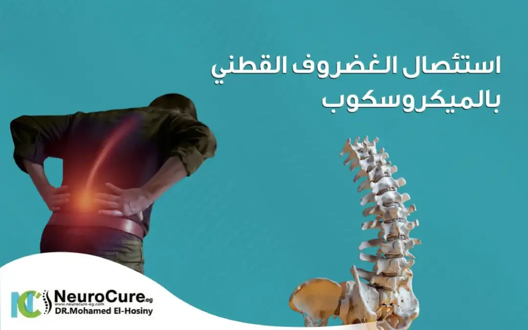 استئصال الغضروف القطني بالميكروسكوب
