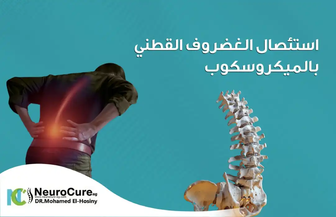 استئصال الغضروف القطني بالميكروسكوب