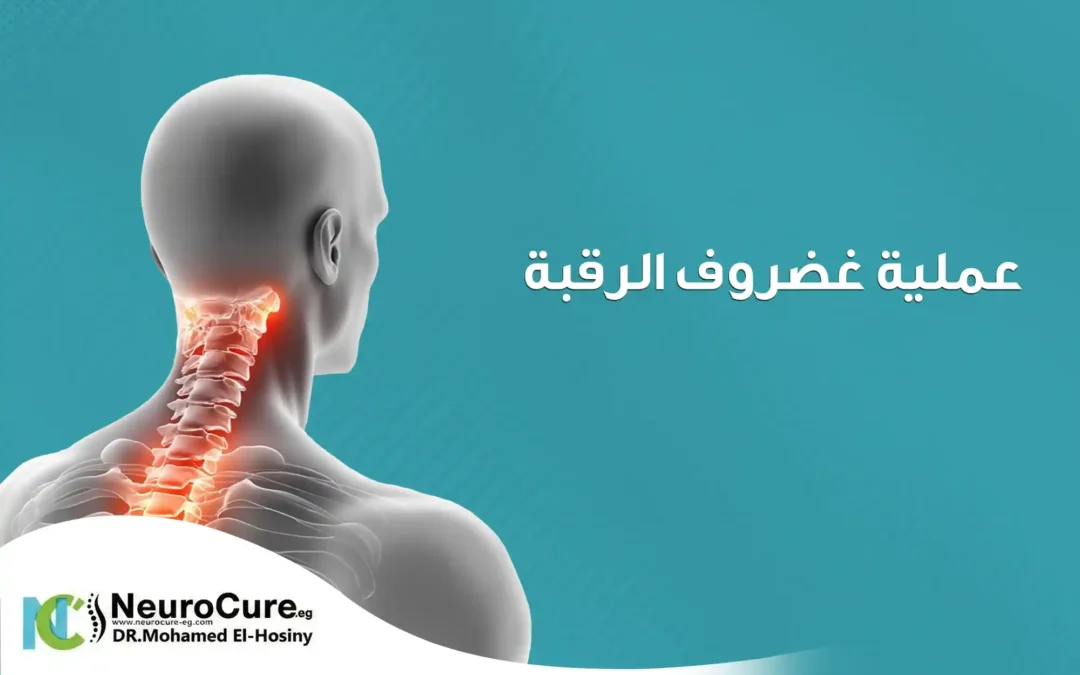 عملية غضروف الرقبة