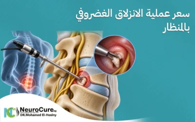 سعر عملية الانزلاق الغضروفي بالمنظار والعوامل المؤثرة عليه