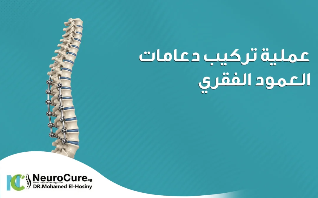 عملية تركيب دعامات العمود الفقري